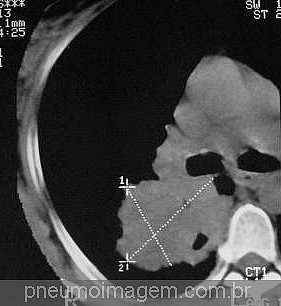 NOVA DROGA APROVADA PARA O TRATAMENTO DO C�NCER DE PULM�O